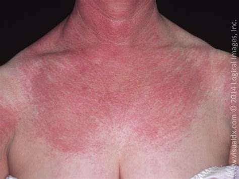 red blotches on chest